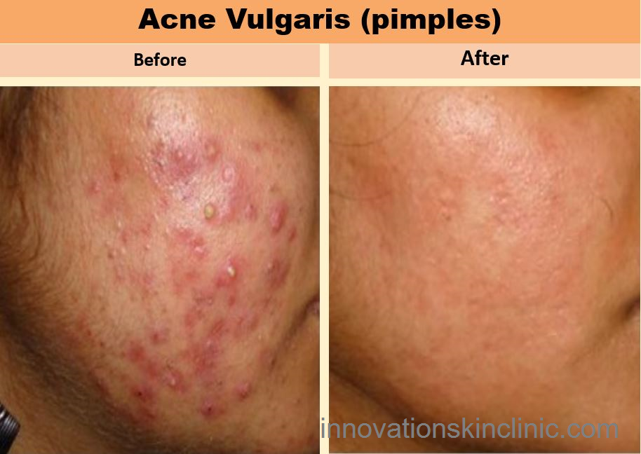Acne Vulgaris Pimples 1